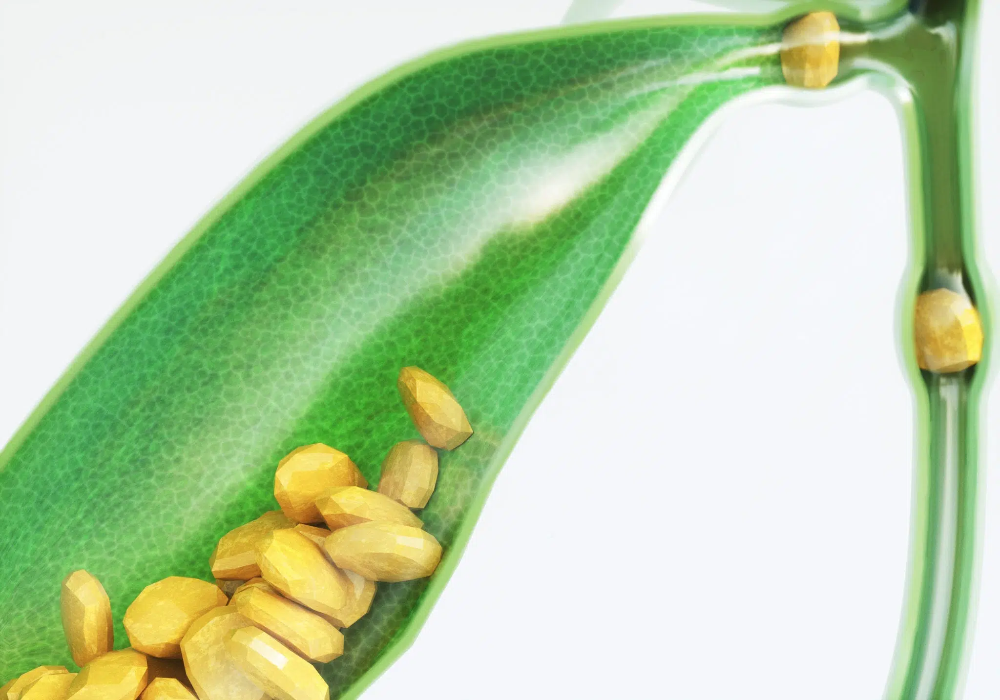 A principal causa de inflamação da vesícula biliar e a obstrução do fluxo de bile pela formação de cálculos.