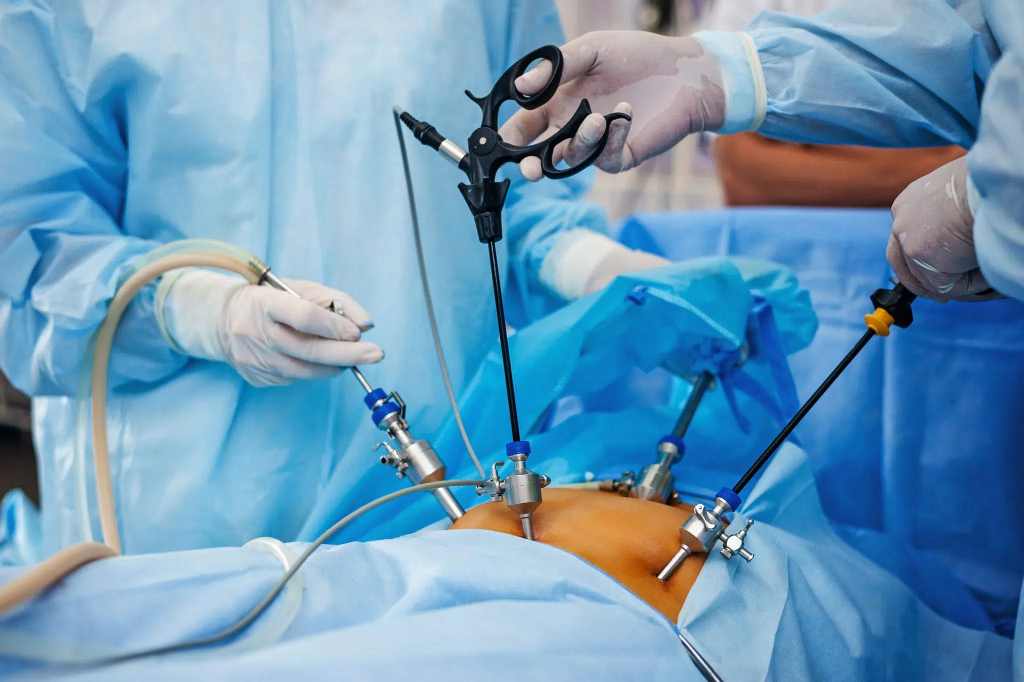 A retirada da vesícula biliar pode ser feita através de cirurgia minimamente invasiva laparoscopia.
