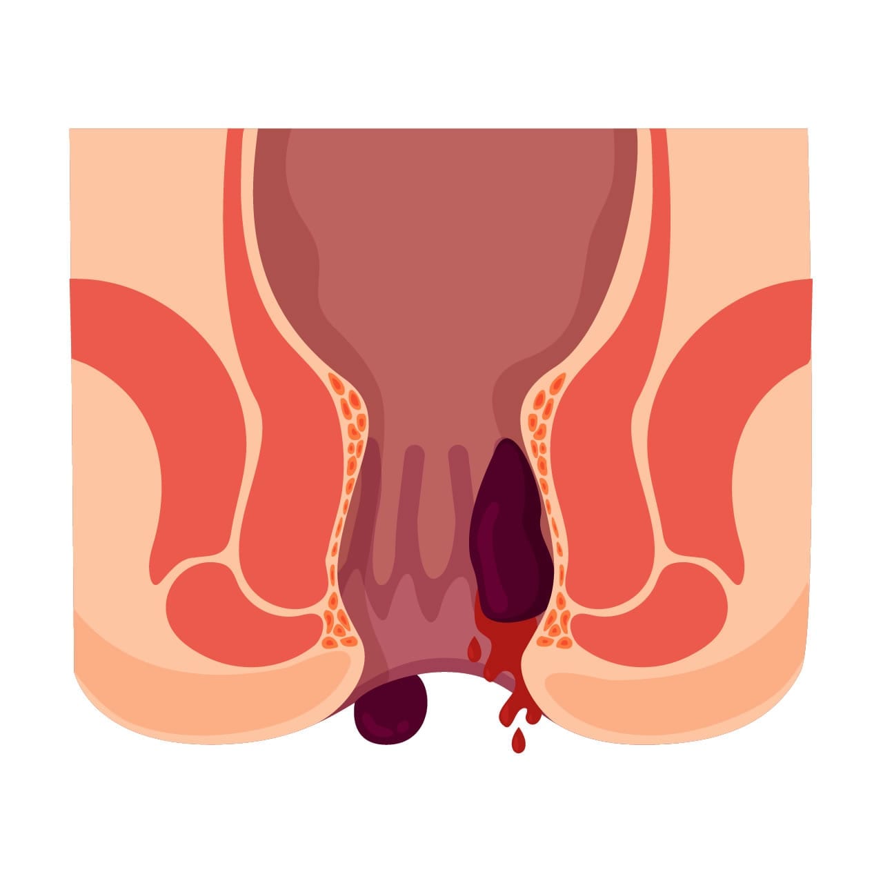 As hemorroidas podem ser internas ou externas ou mistas