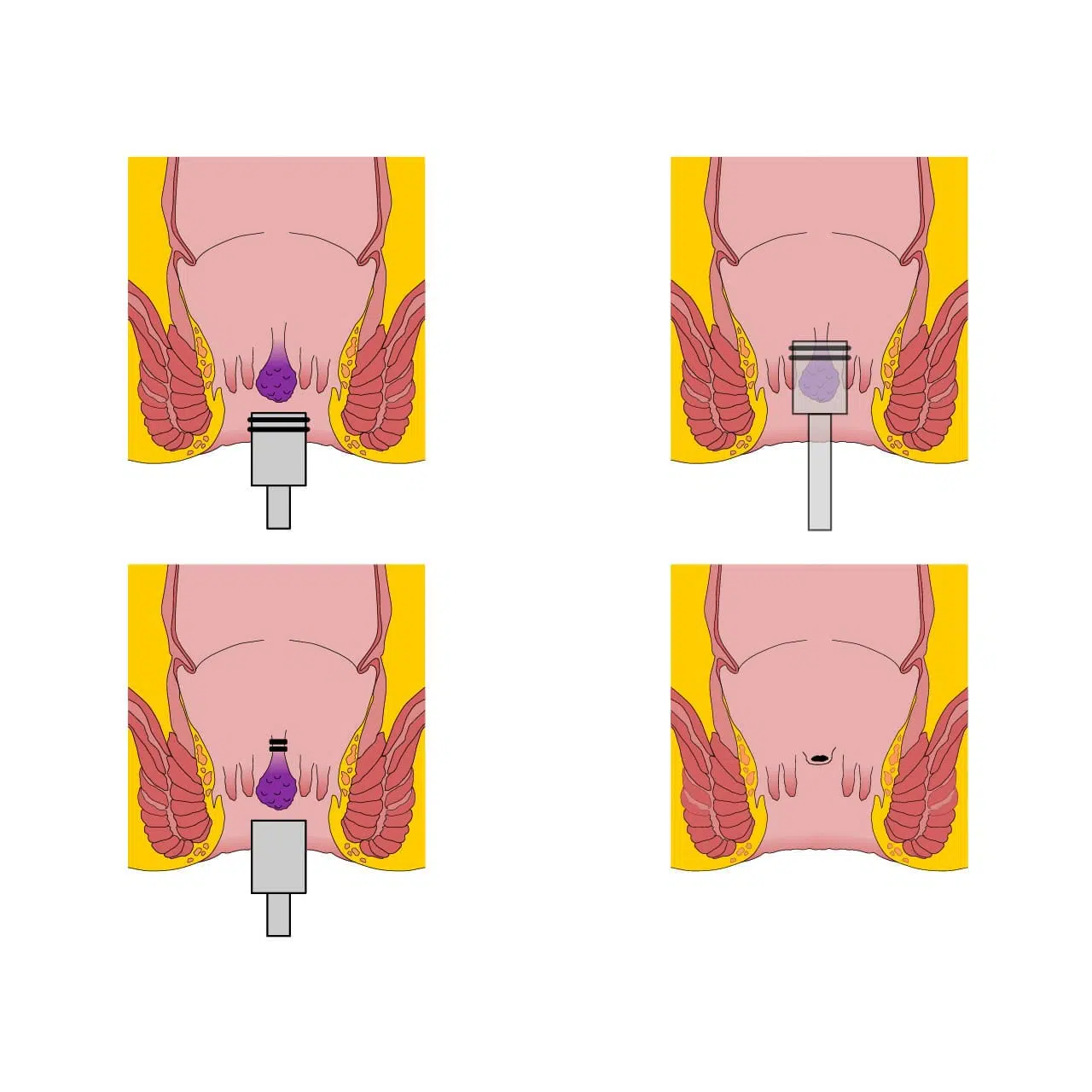 ligadura elástica (estrangulamento) de hemorroidas internas é realizada no próprio consultório médico.